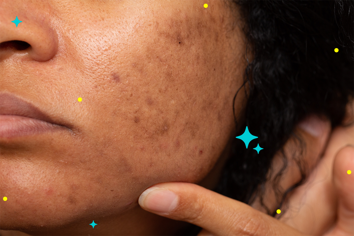 Cómo prevenir las manchas en la piel: consejos y estrategias