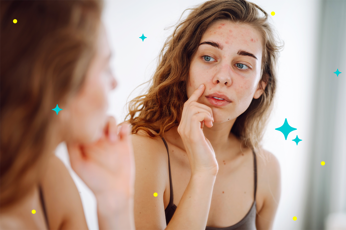 ¿Cómo saber si tu acné es hormonal? Claves para identificarlo y tratarlo correctamente